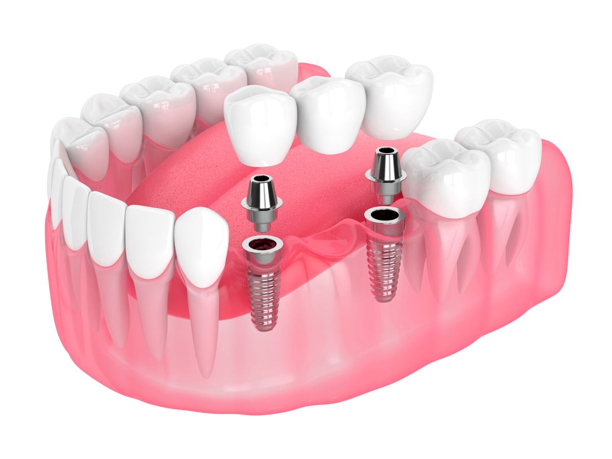 dental crowns and bridges